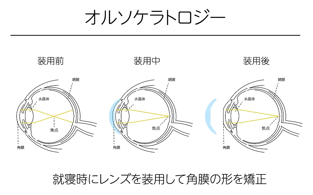 近視が矯正されるしくみ